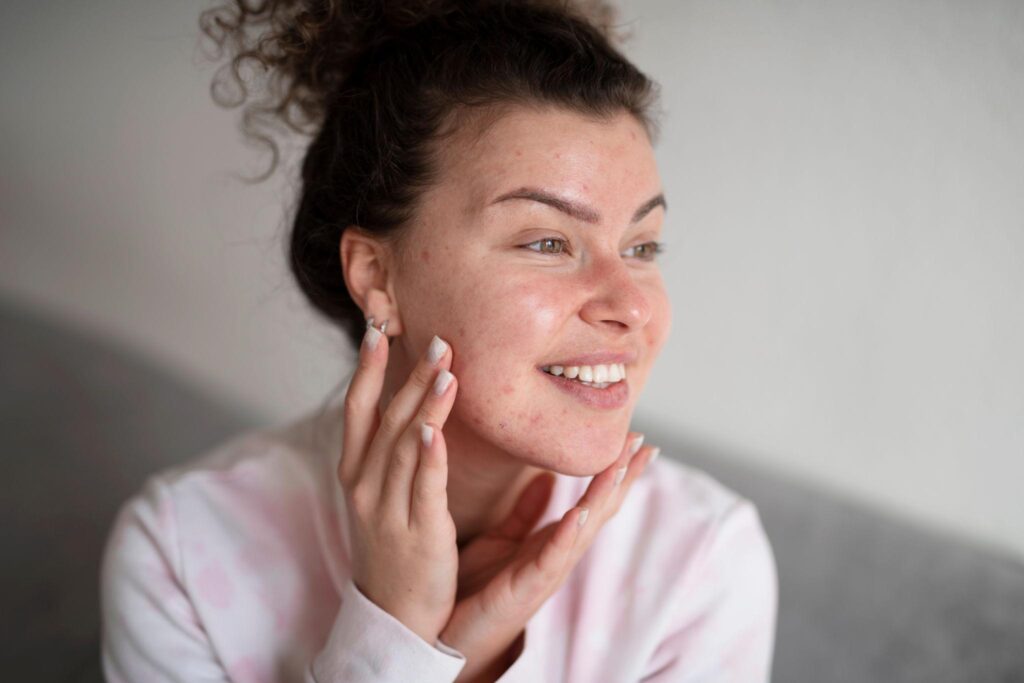 Woman with clear acne-prone skin after using natural ghee face serum
